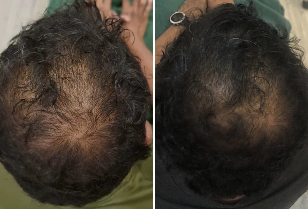 mrcclinic-Hair-Regrowth-1