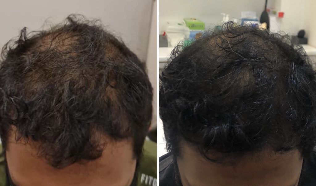 mrcclinic-Hair-Regrowth