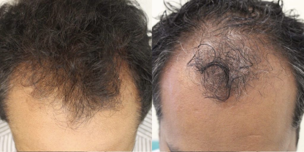 mrcclinic-Hair-Regrowth-2