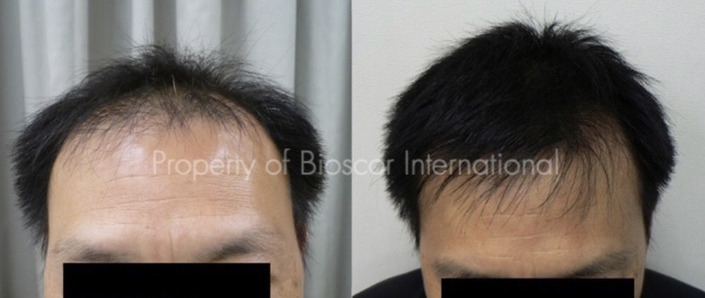 mrcclinic-Hair-Regrowth-3
