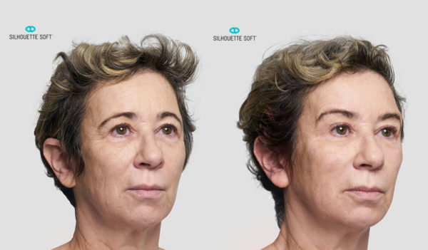 Before-and-After-Silhouette-Soft-Thread-Lifts-001-collagen-stimulating-sutures-mrcclinic-Melbourne-Facelift-face-lift-1-600x351