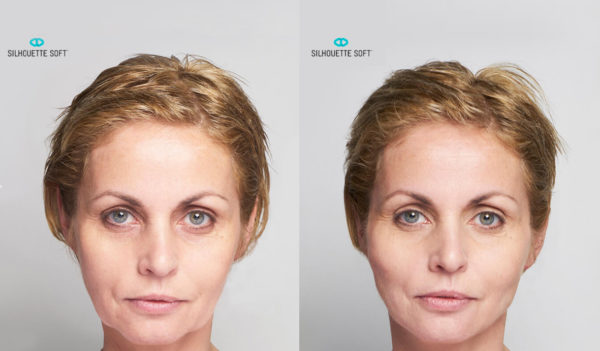 Before-and-After-Silhouette-Soft-Thread-Lifts-002-collagen-stimulating-sutures-mrcclinic-Melbourne-Facelift-face-lift-1-600x351