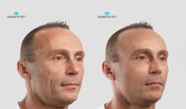 Before-and-After-Silhouette-Soft-Thread-Lifts-003-collagen-stimulating-sutures-mrcclinic-Melbourne-Facelift-face-lift-1-600x351