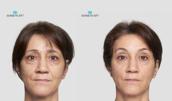 Before-and-After-Silhouette-Soft-Thread-Lifts-004-collagen-stimulating-sutures-mrcclinic-Melbourne-Facelift-face-lift-1-600x351