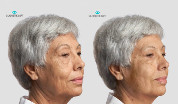 Before-and-After-Silhouette-Soft-Thread-Lifts-005-collagen-stimulating-sutures-mrcclinic-Melbourne-Facelift-face-lift-600x351